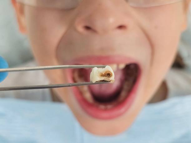 Best Emergency Tooth Extraction in Sparta, WI